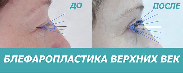 Блефаропластика верхніх повік, фото 1